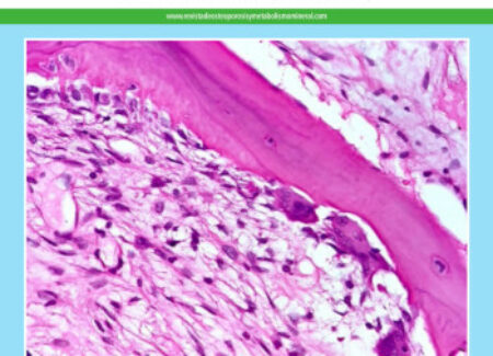 REVISTA DE OSTEOPOROSIS Y METABOLISMO MINERAL VOLUMEN 16. NÚM. 2.